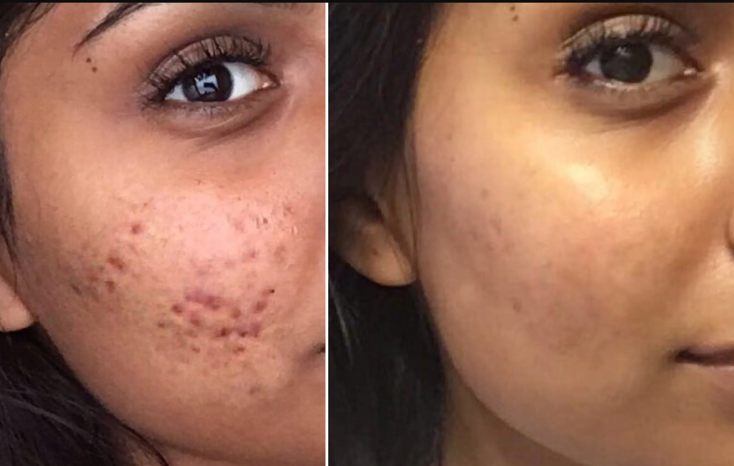Bye Bye Acne Protocol