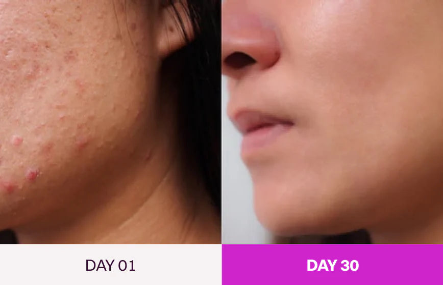 Bye Bye Acne Protocol