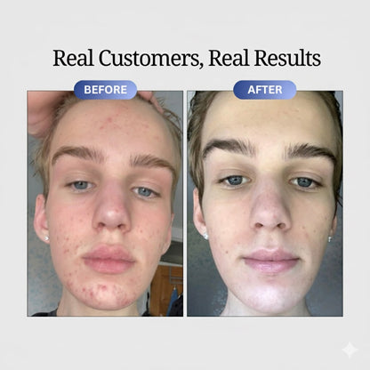 Bye Bye Acne Protocol